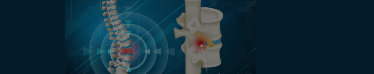 Slip Disc or Herniated Disc