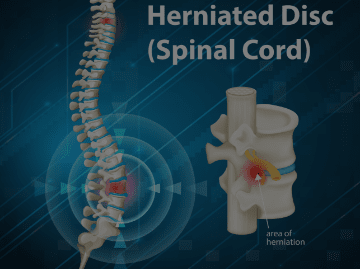 Slip Disc or Herniated Disc