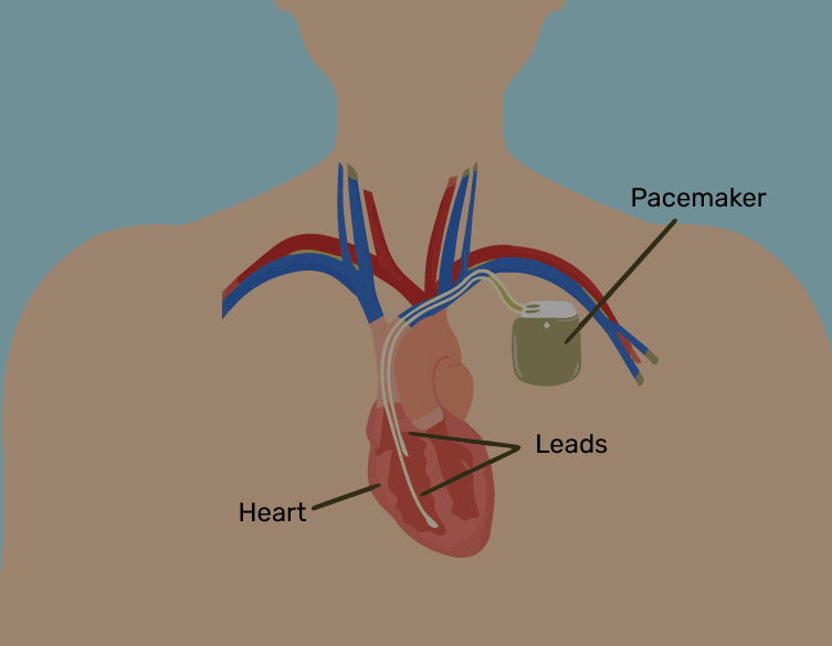 Pacemaker Implantation