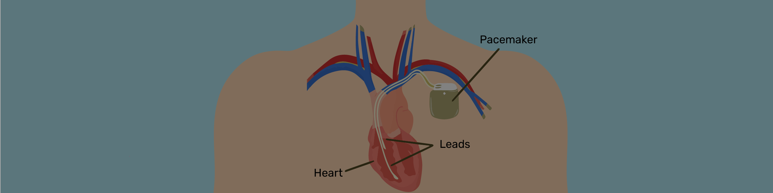 Pacemaker Implantation