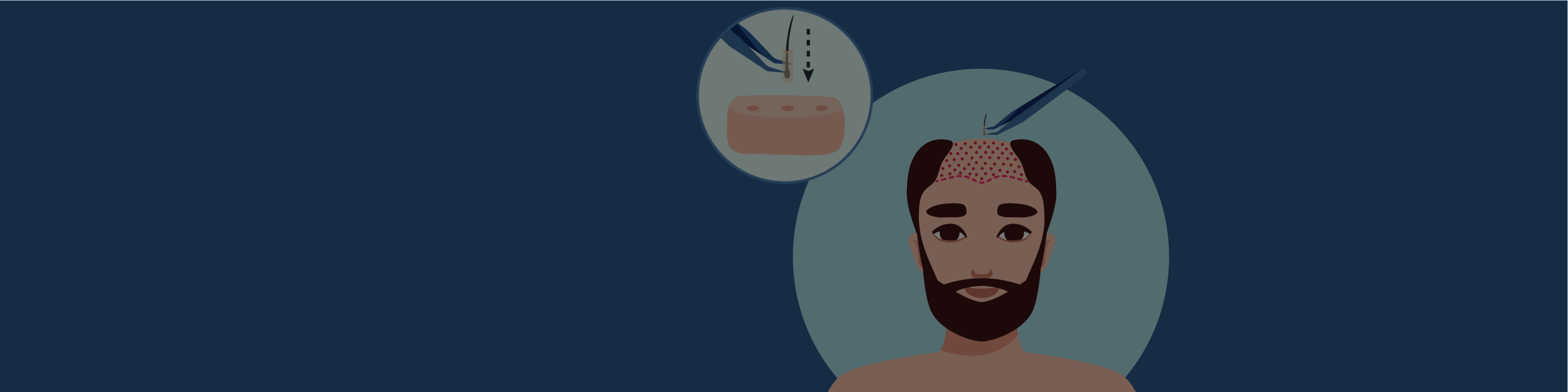 Hair Transplant